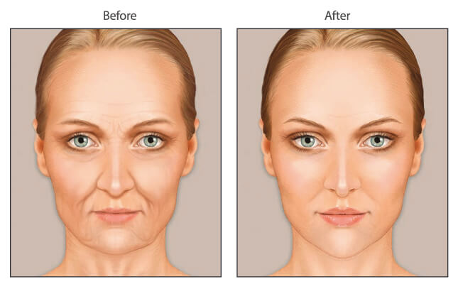 Antes e depois do enxerto de gordura no rosto Enxerto de gordura na parte do rosto