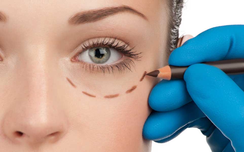 Blefaroplastia parte do rosto de uma mulher com linha tracejada abaixo do olho antes de uma Blefaroplastia