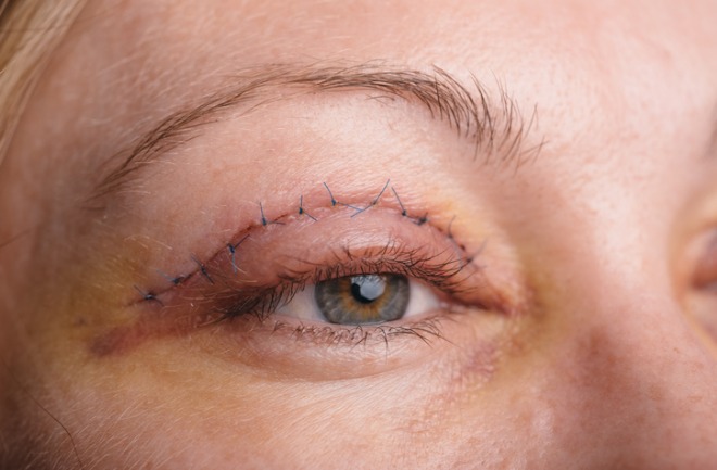 conheça alguns cuidados relevante após a realização da blefaroplastia mulher após realização de blefaroplastia