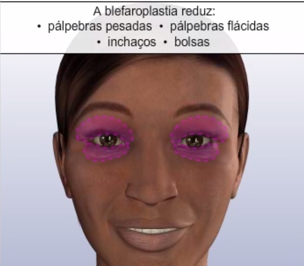 A Blerafoplastia reduz pálpebras pesadas, flácidas, inchaços e bolsas A Blerafoplastia reduz pálpebras pesadas, flácidas, inchaços e bolsas