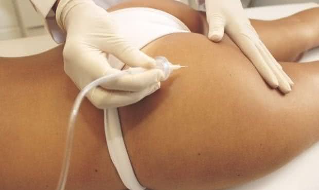 Carboxiterapia no gluteo para tratamento de estrias Carboxiterapia para estrias