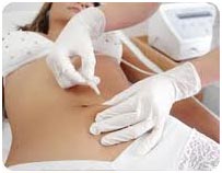 carboxiterapia