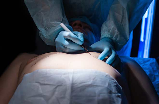 descubra o que é e para que serve a cirurgia de ginecomastia médico realizando cirurgia de ginecomastia em homem