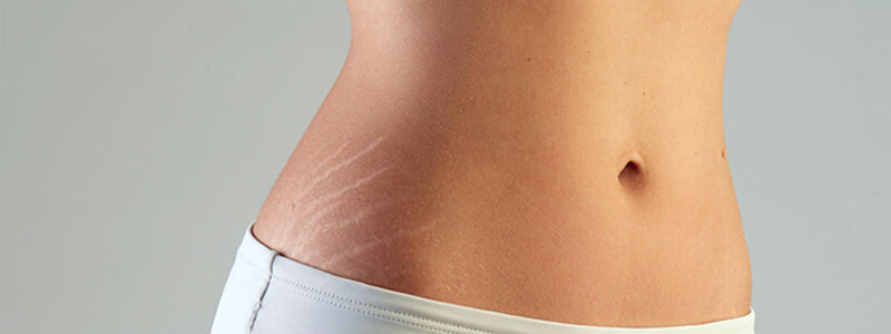 Estrias na barriga Estrias