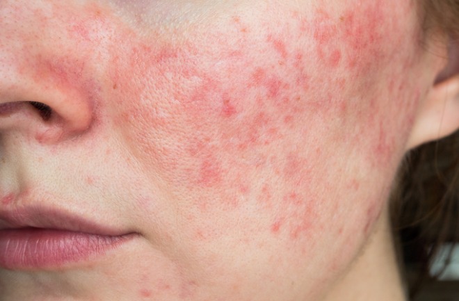 conheça as quatro fases da acne e seus respectivos tratamentos mulher sofrendo com fases da acne