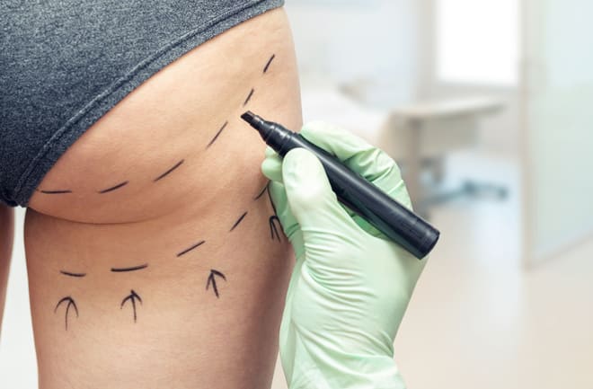 Lipo lad nos glúteos Lipo lad pode ser feita em quais áreas do corpo?