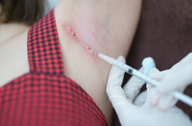 saiba as possibilidades de desenvolvver quelóide após uma cirurgia plástica mulher recebendo injeção de corticódies após desenvolver quelóide na cicatrização de cirurgia plástica