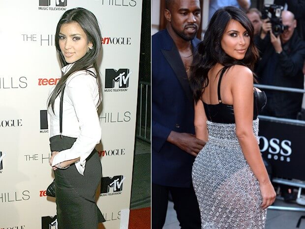 kim kardashian cirurgia plastica
