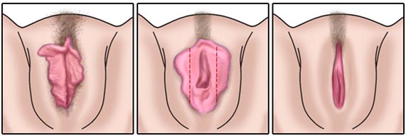 Ninfoplastia - A cirurgia íntima