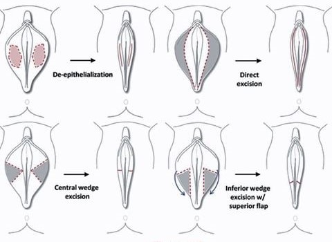 ilustração de tecnicas da cirurgia ninfoplastia