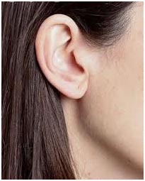 otoplastia