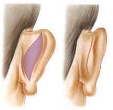 cirurgia de orelha