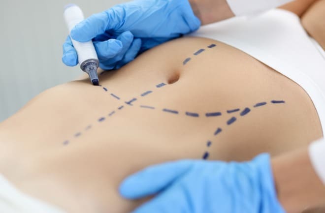 mulher realizando nova abdominoplastia