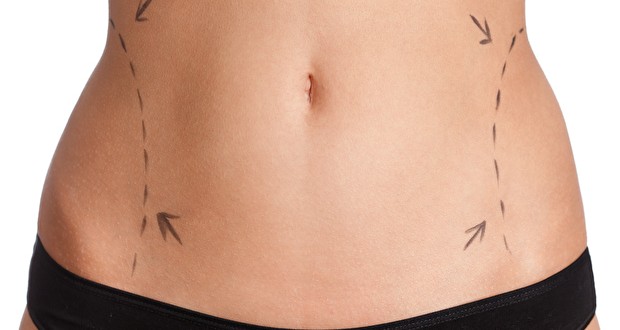 Imagem com o quadril marcado para a cirurgia Lipoaspiração Quadril