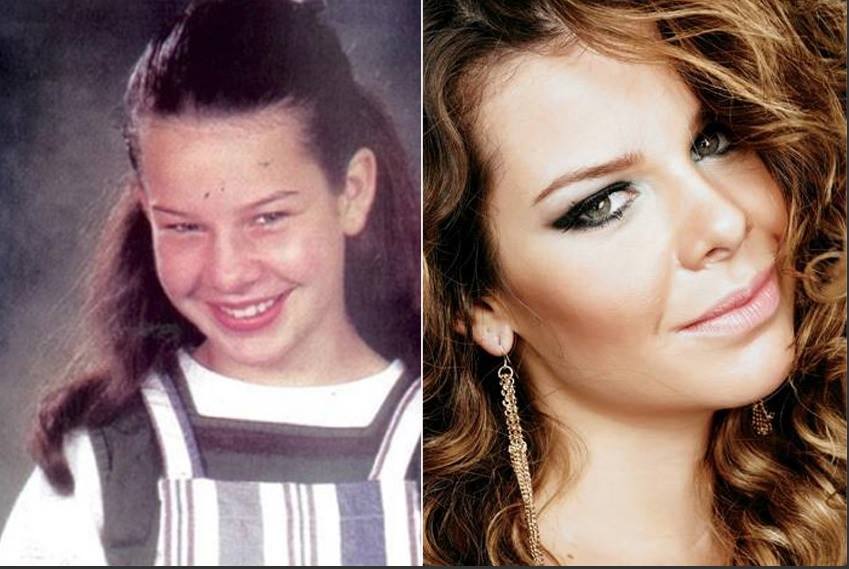rinoplastia fernanda souza