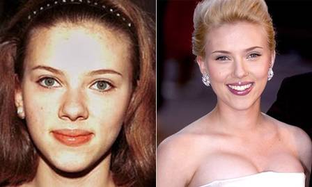 scarlett johnson cirurgia plastica