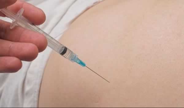 Mulher Eliminando Estrias com Subcisão Procedimento Para Estrias Subcisão