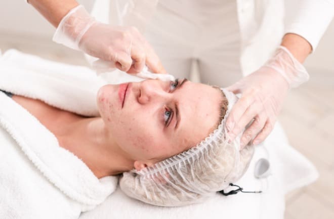 tratamentos estéticos para acne